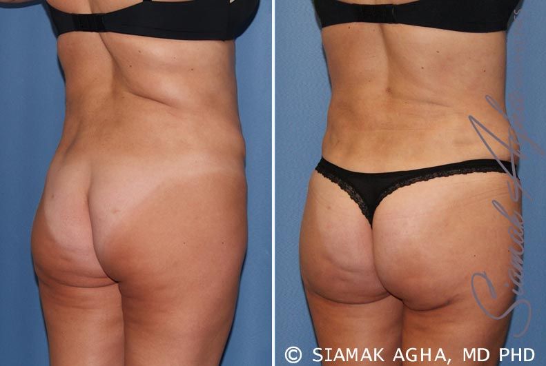 Tummy Tuck Revision Before & After