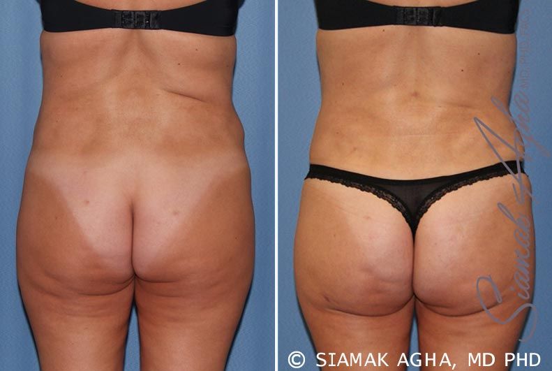 Tummy Tuck Revision Before & After