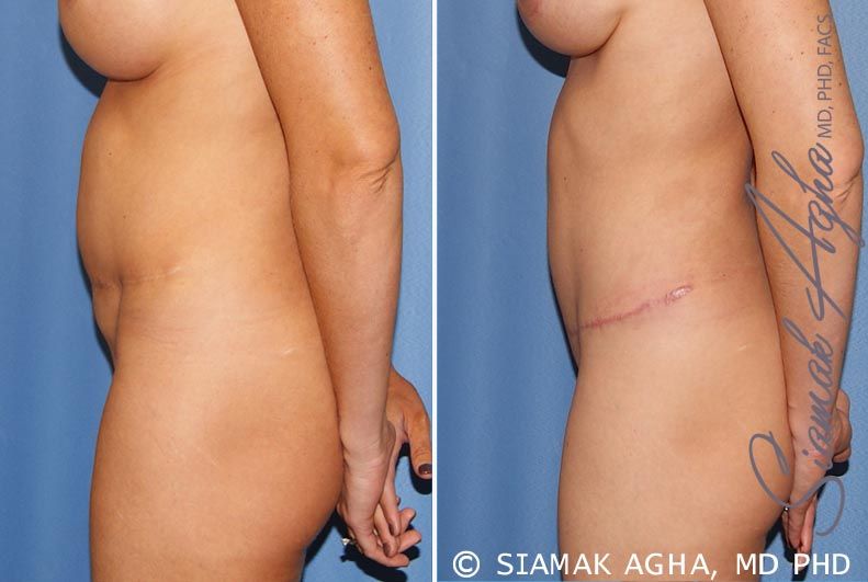 Tummy Tuck Revision Before & After