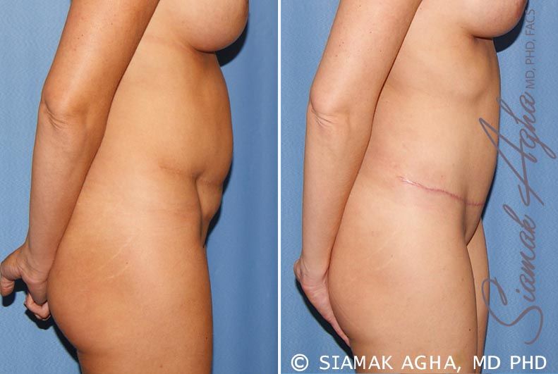 Tummy Tuck Revision Before & After