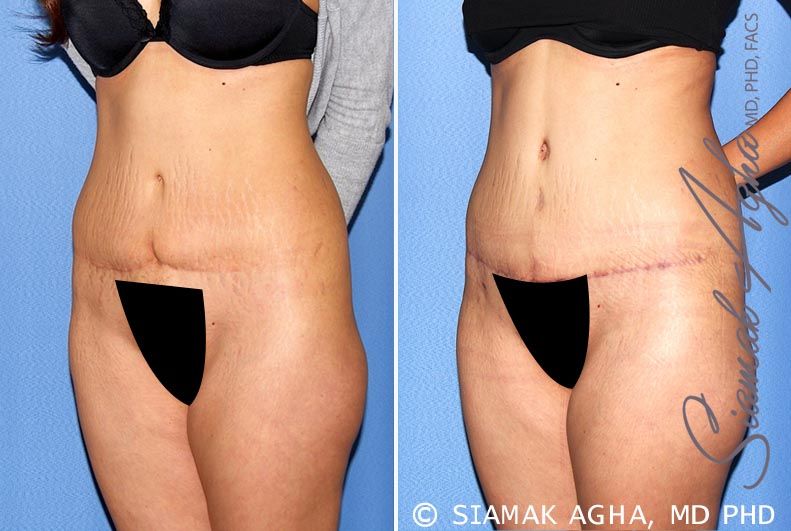 Tummy Tuck Revision Before & After
