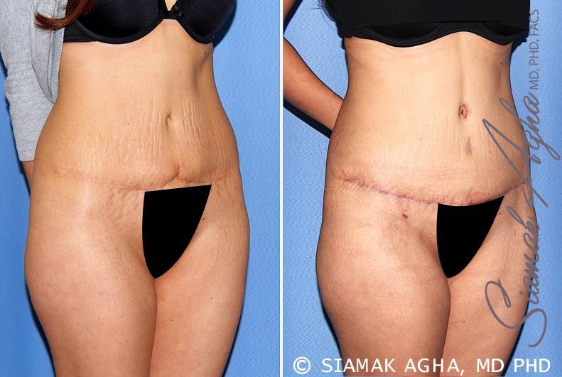 Tummy Tuck Revision Before & After