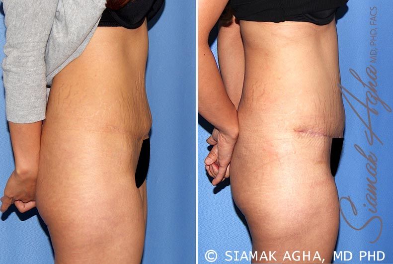 Tummy Tuck Revision Before & After