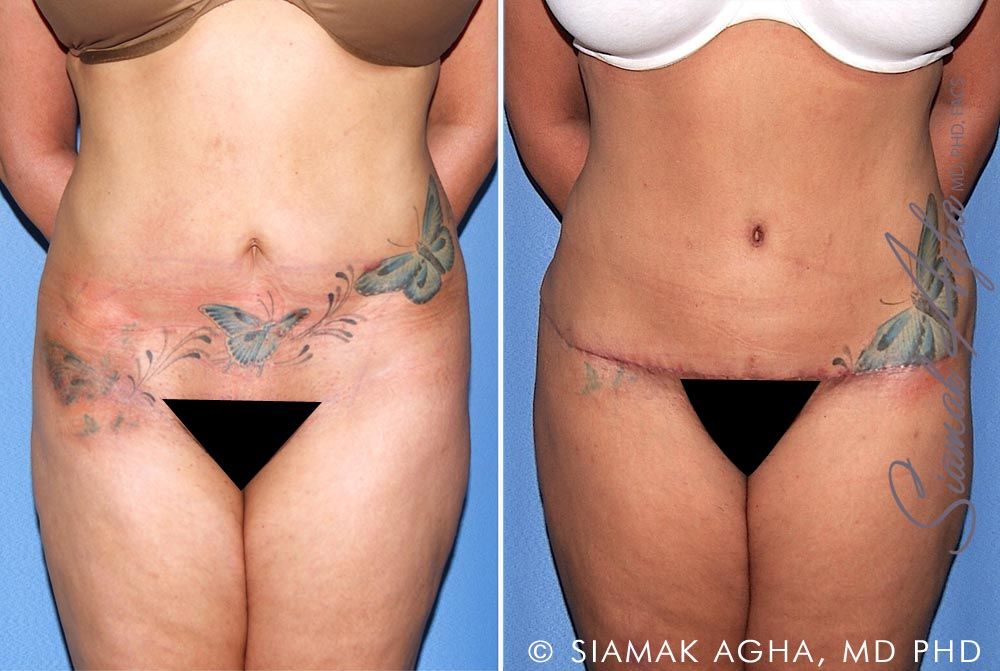 Tummy Tuck Revision Before & After
