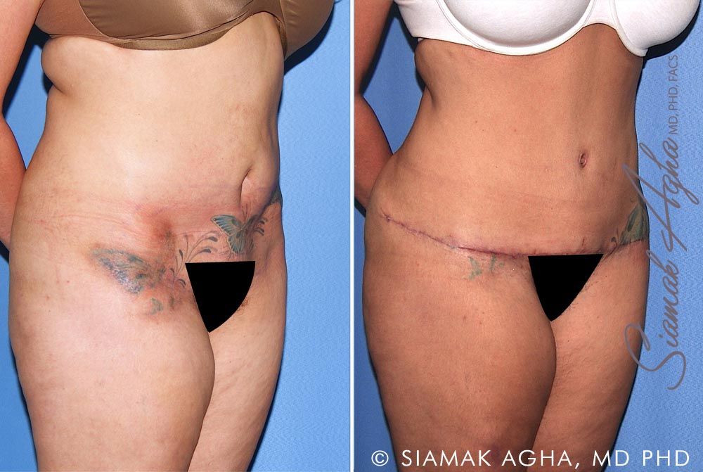 Tummy Tuck Revision Before & After