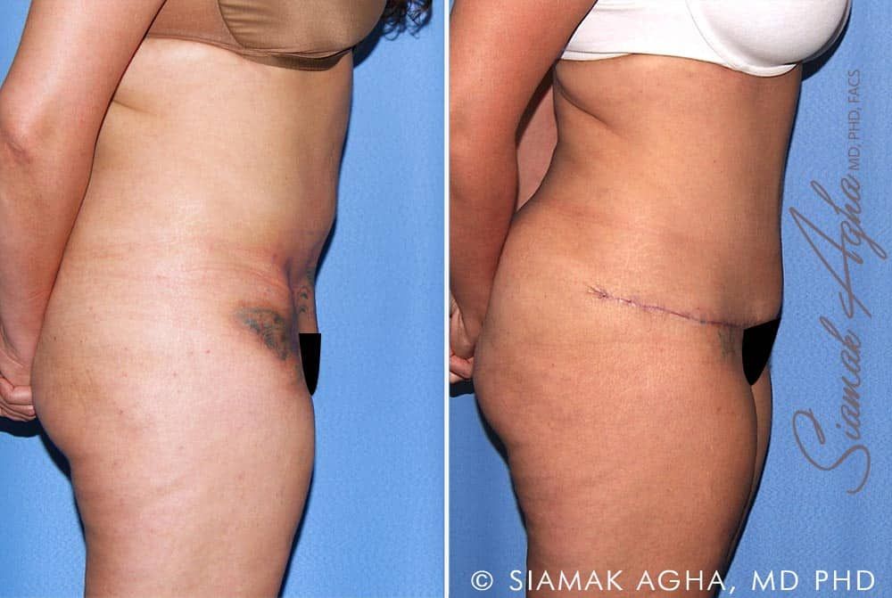 Tummy Tuck Revision Before & After