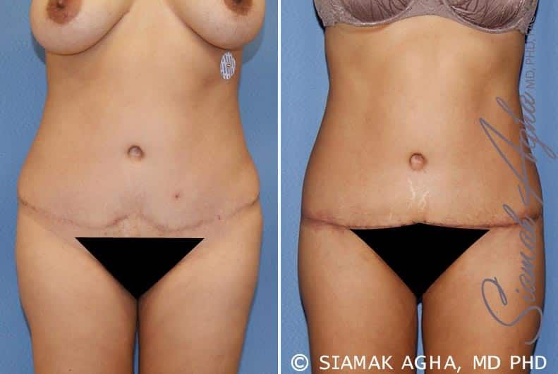 Tummy Tuck Revision Before & After