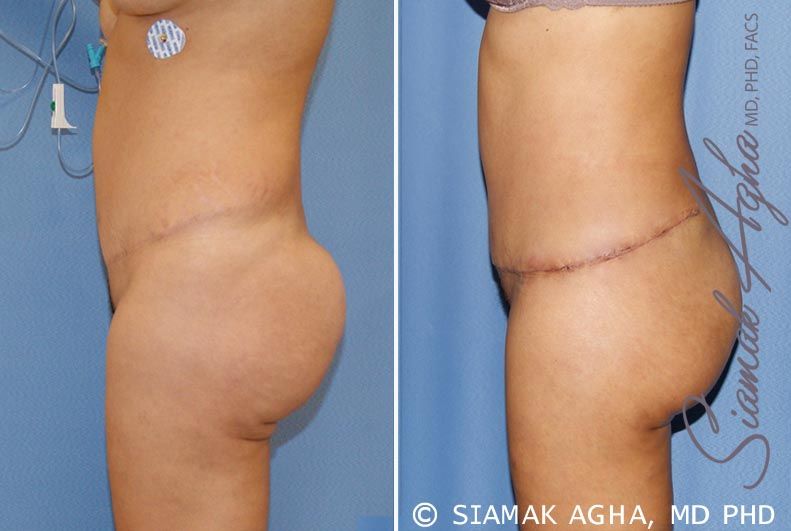 Tummy Tuck Revision Before & After