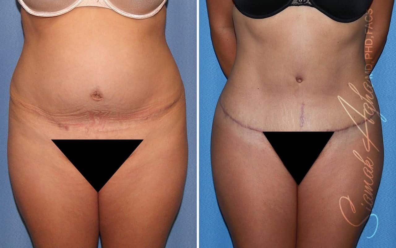 Tummy Tuck Revision Before & After