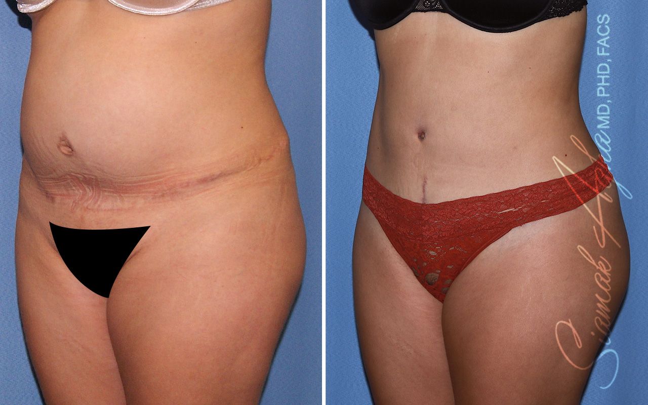 Tummy Tuck Revision Before & After