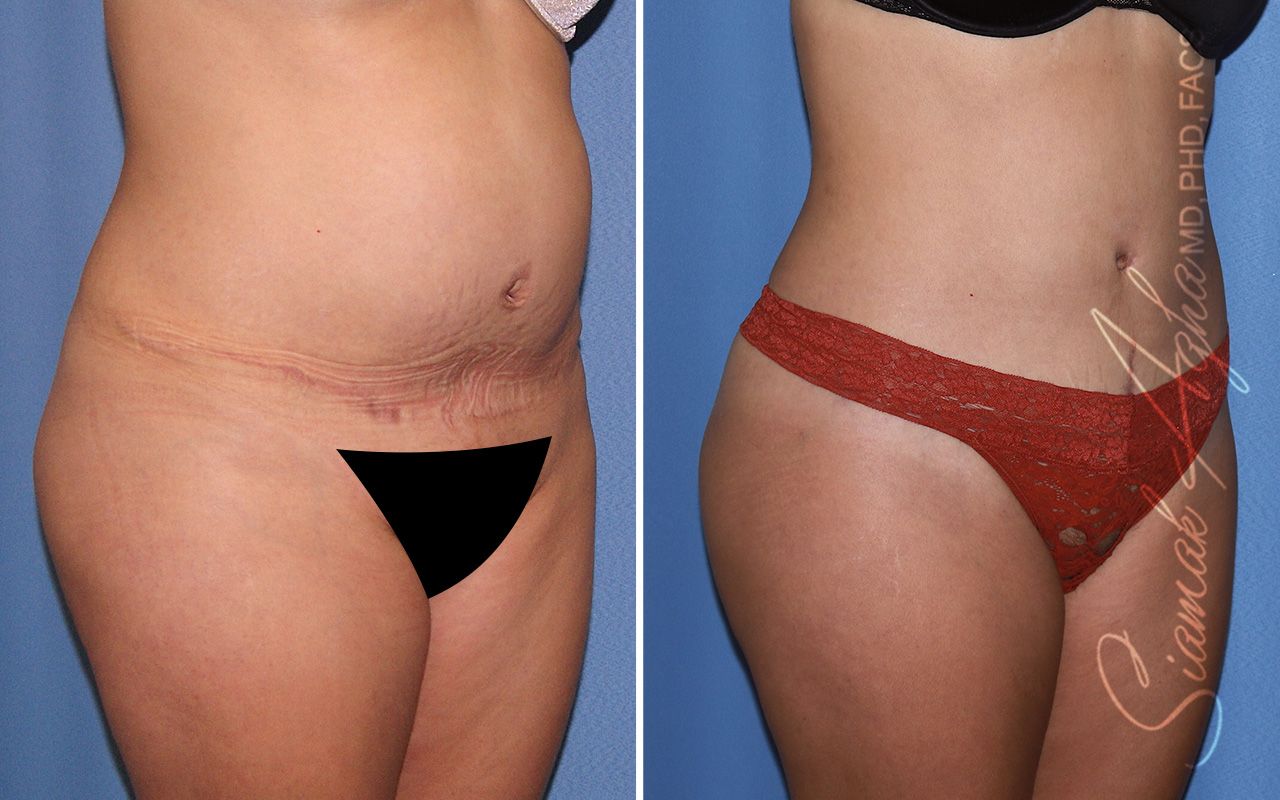 Tummy Tuck Revision Before & After