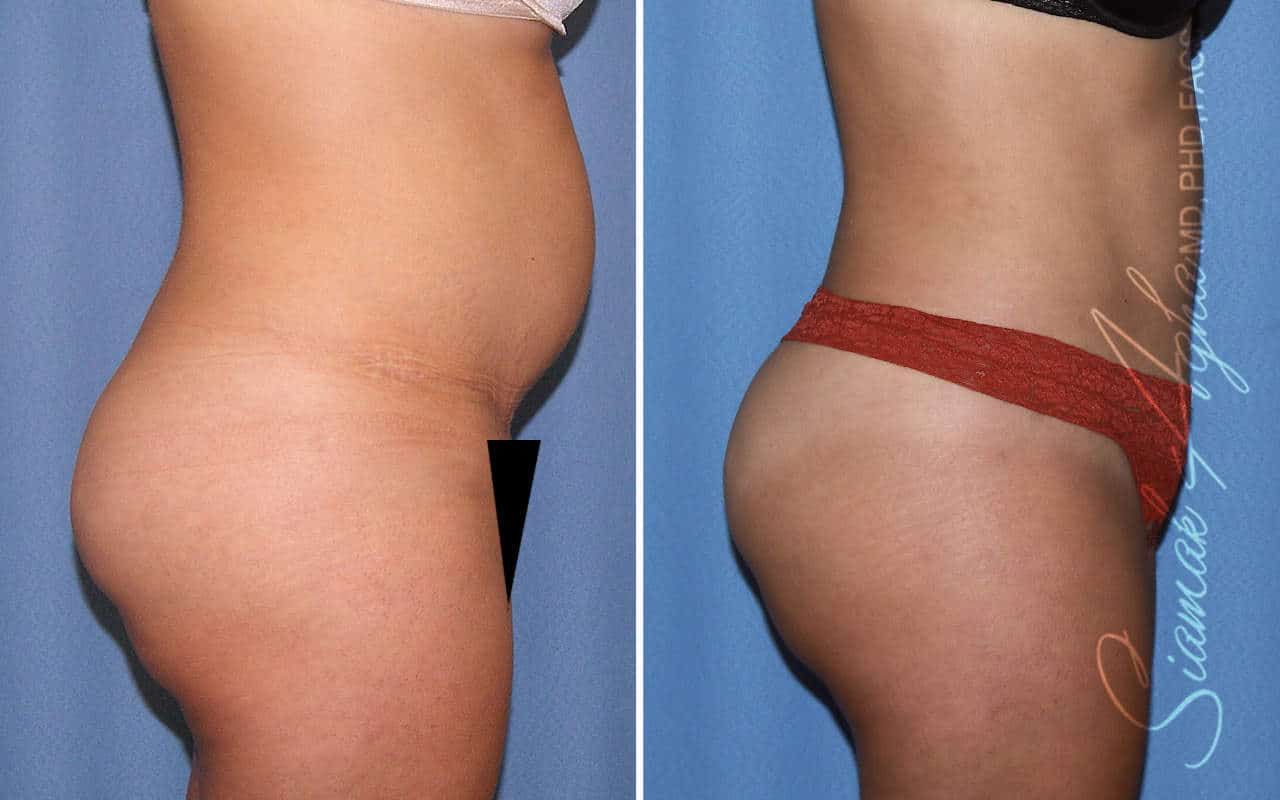 Tummy Tuck Revision Before & After