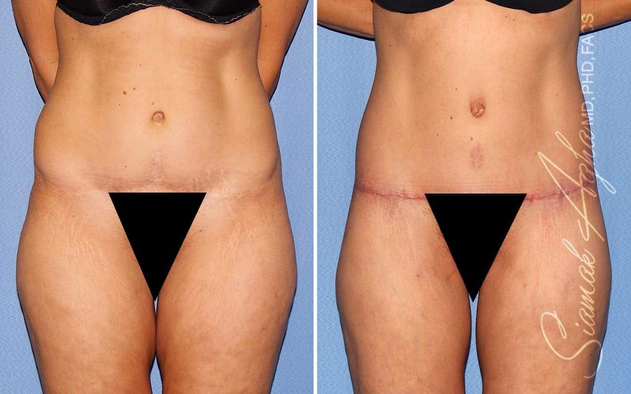 Tummy Tuck Revision Before & After