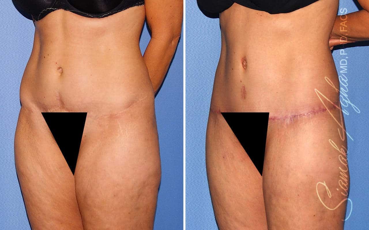 Tummy Tuck Revision Before & After