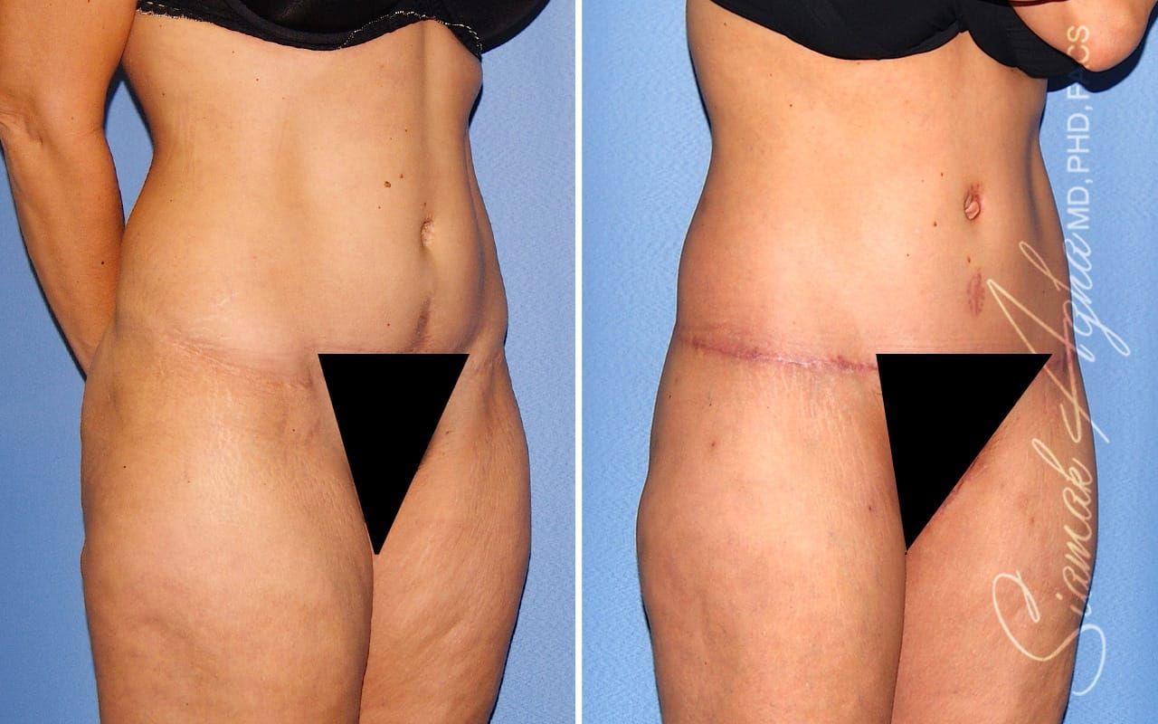 Tummy Tuck Revision Before & After