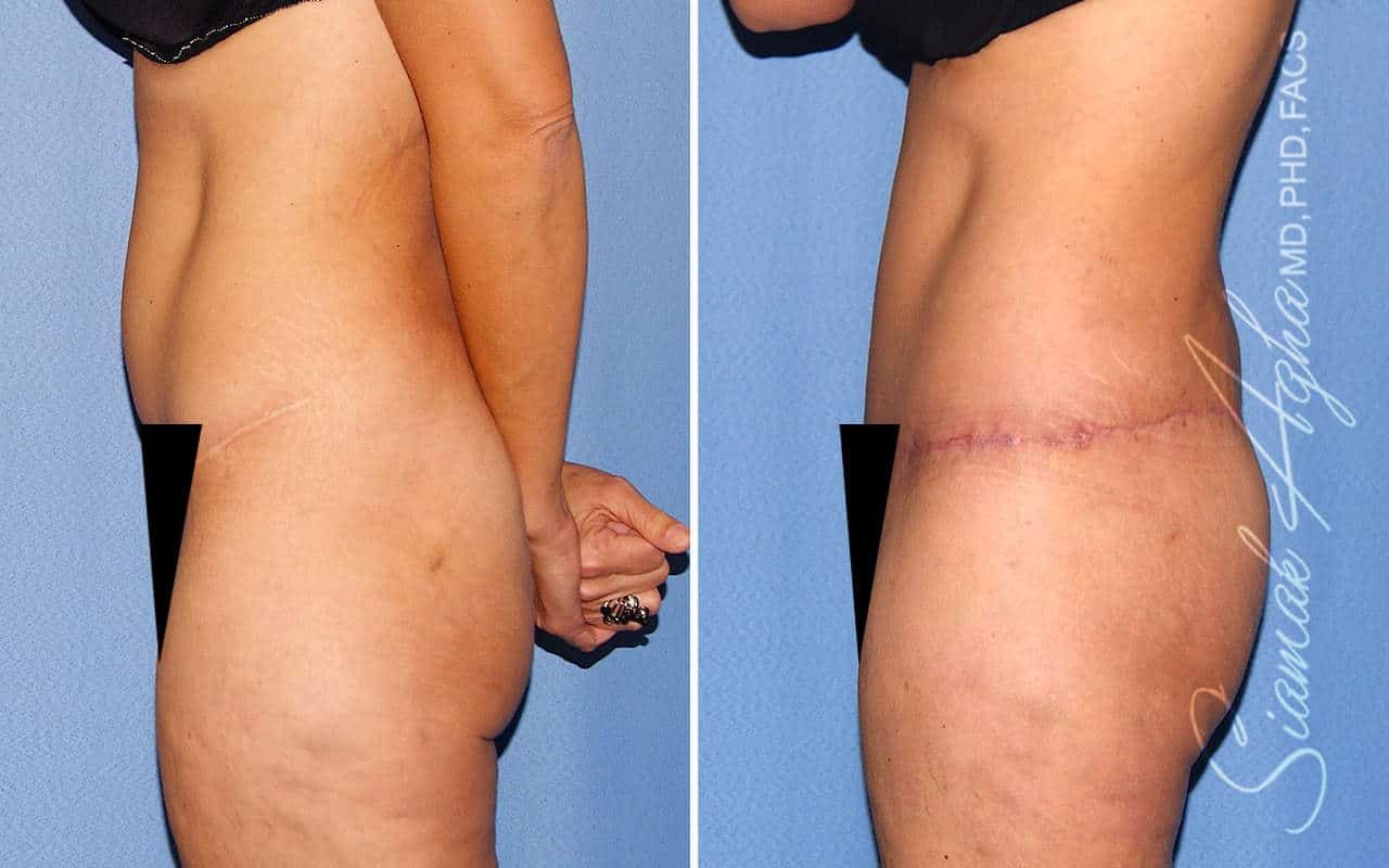 Tummy Tuck Revision Before & After