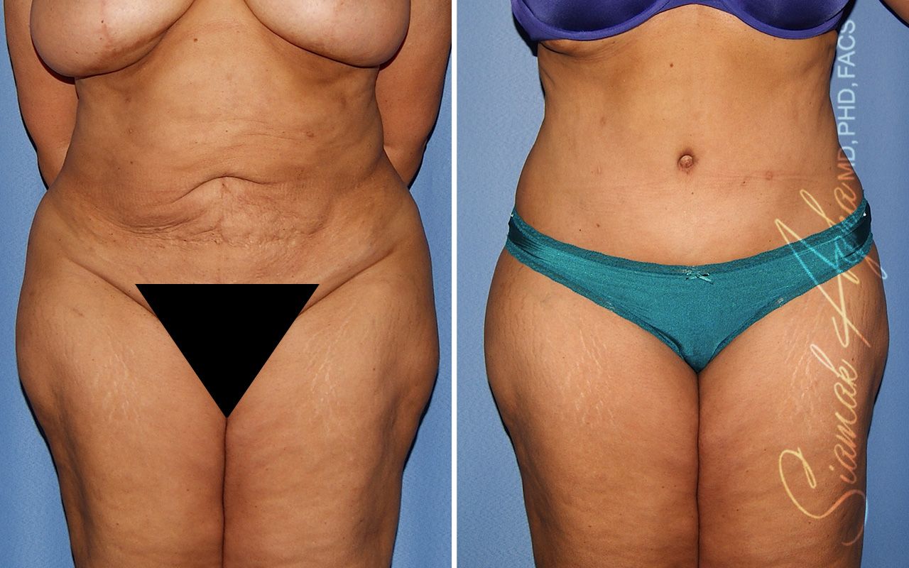 Tummy Tuck Revision Before & After