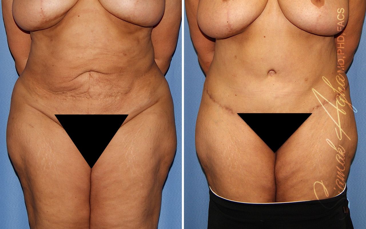 Tummy Tuck Revision Before & After