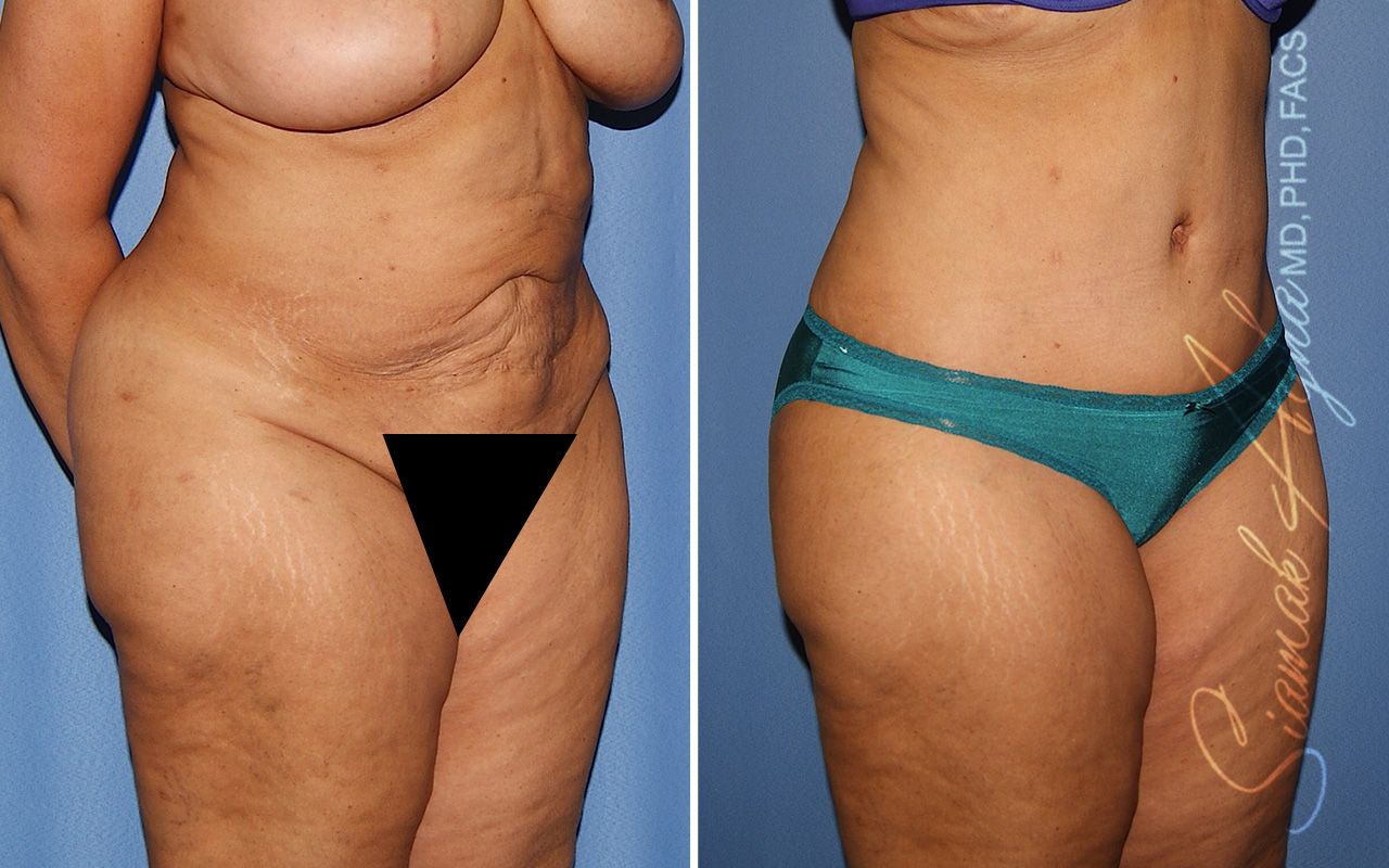 Tummy Tuck Revision Before & After