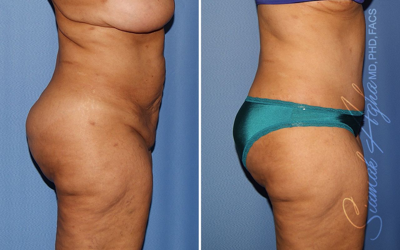 Tummy Tuck Revision Before & After