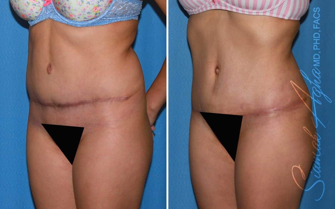 Tummy Tuck Revision Before & After