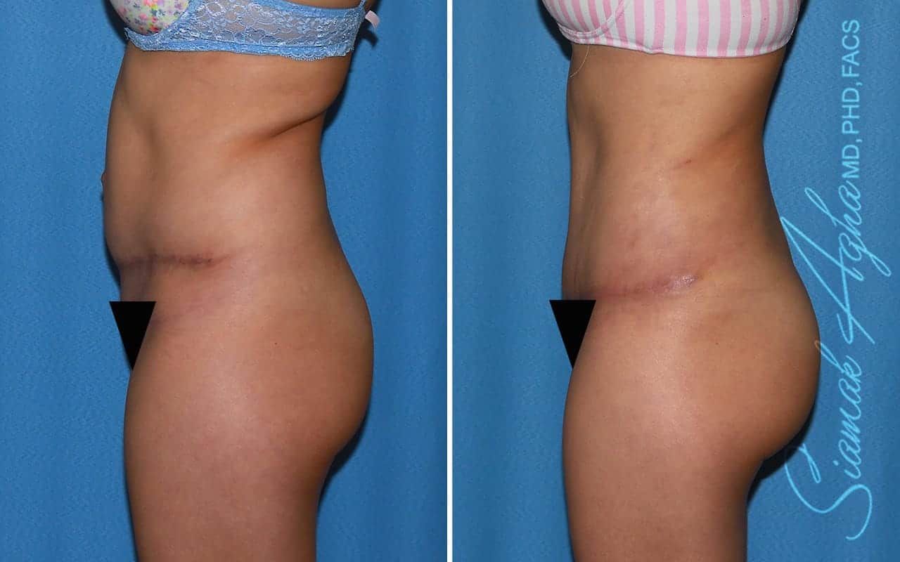 Tummy Tuck Revision Before & After