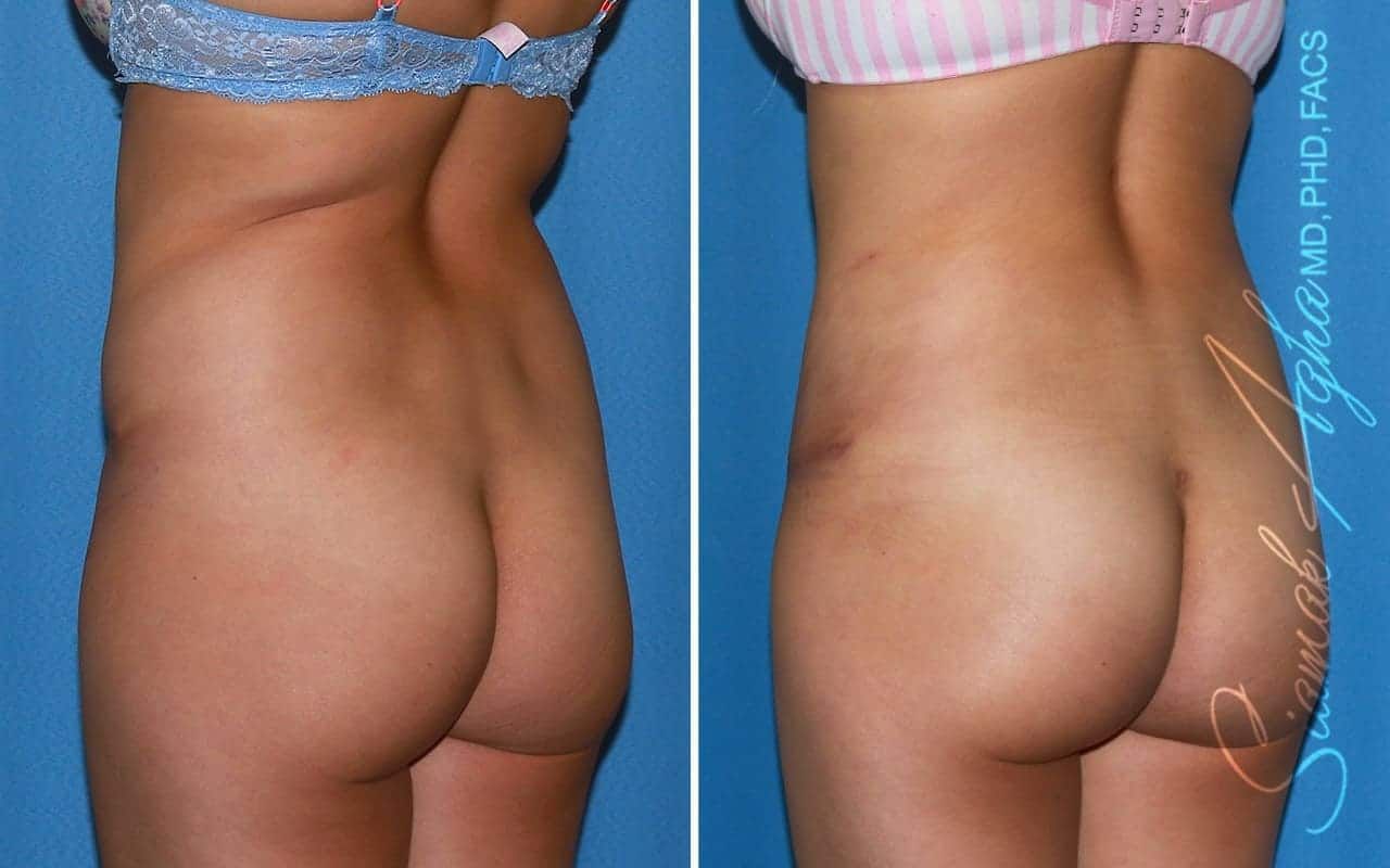 Tummy Tuck Revision Before & After