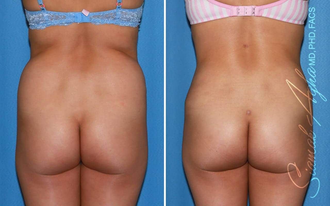Tummy Tuck Revision Before & After