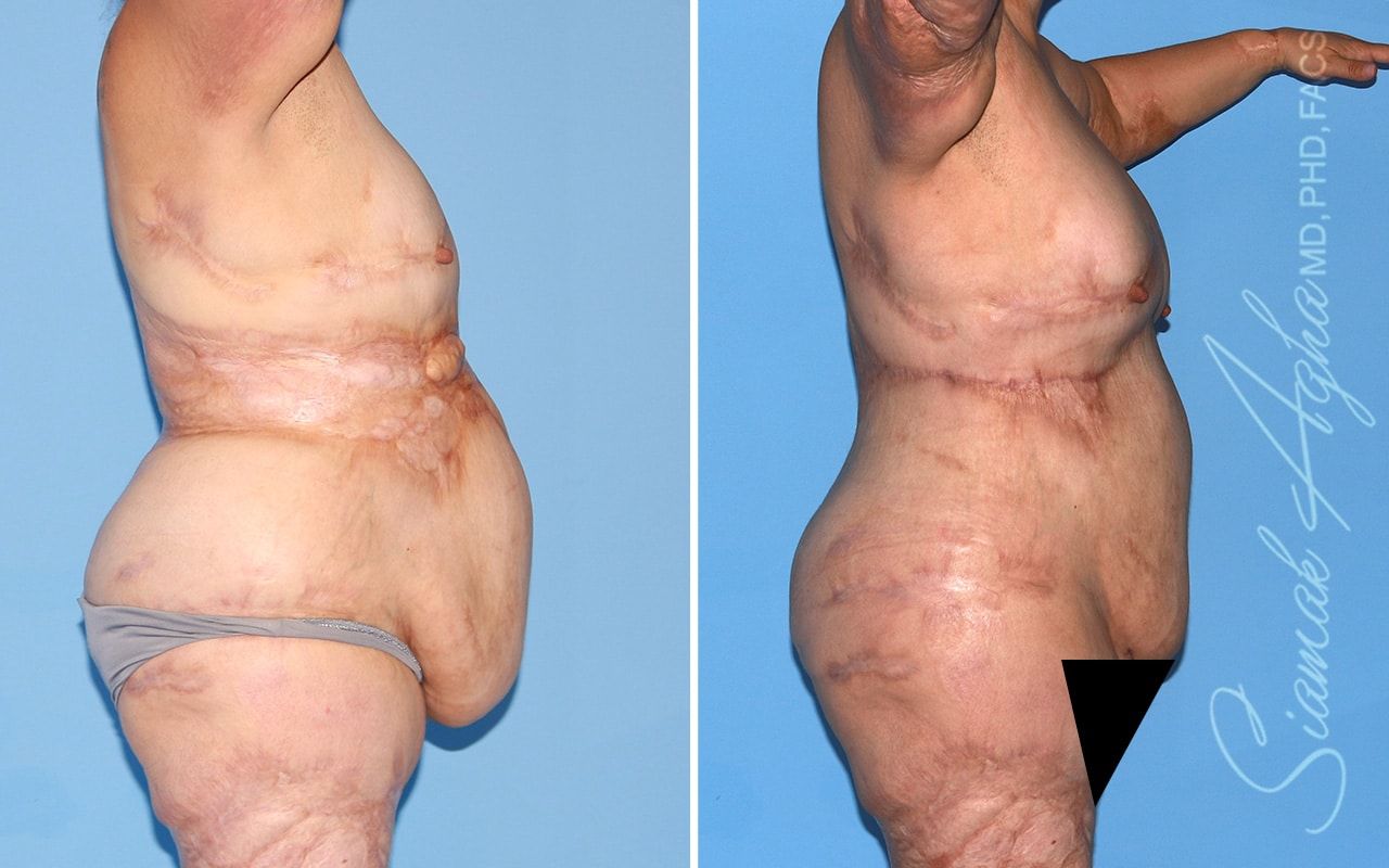Reverse Tummy Tuck Before & After