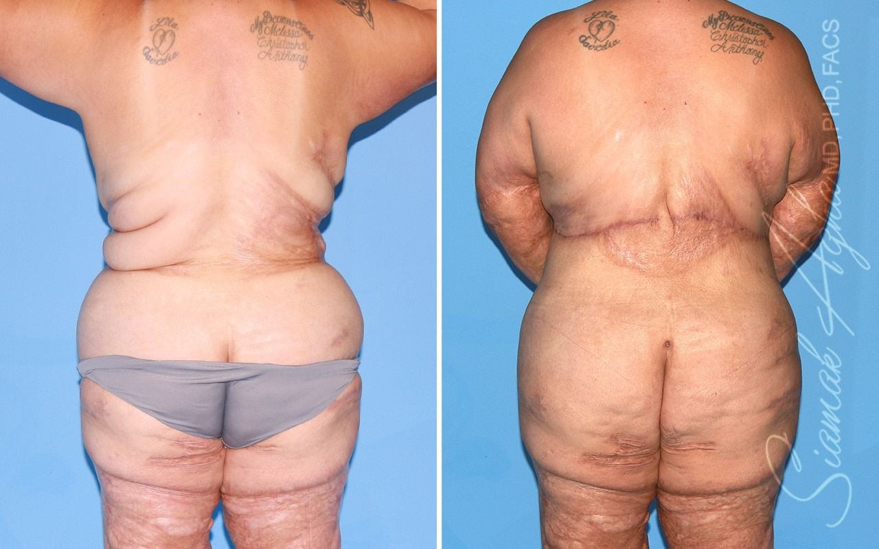 Reverse Tummy Tuck Before & After