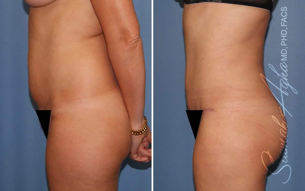 Partial Tummy Tuck Before & After