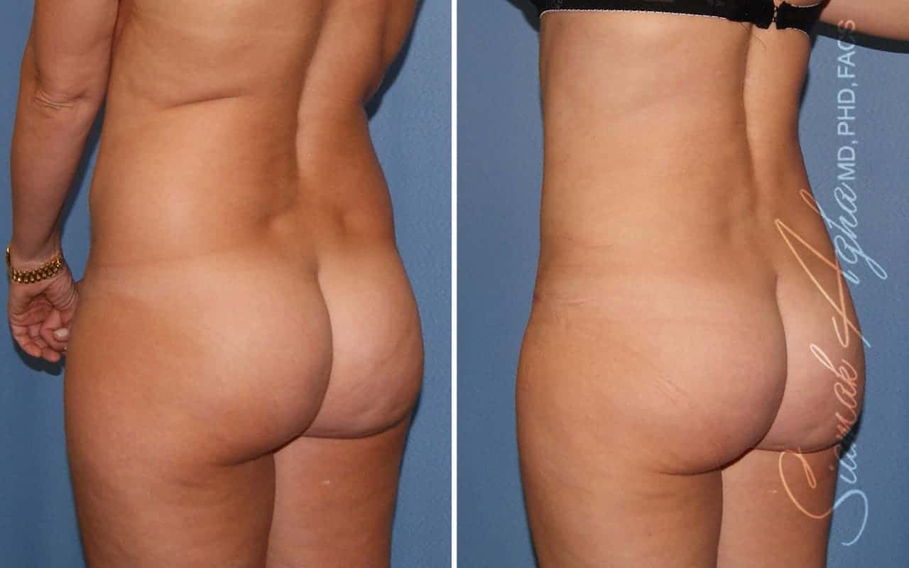 Partial Tummy Tuck Before & After