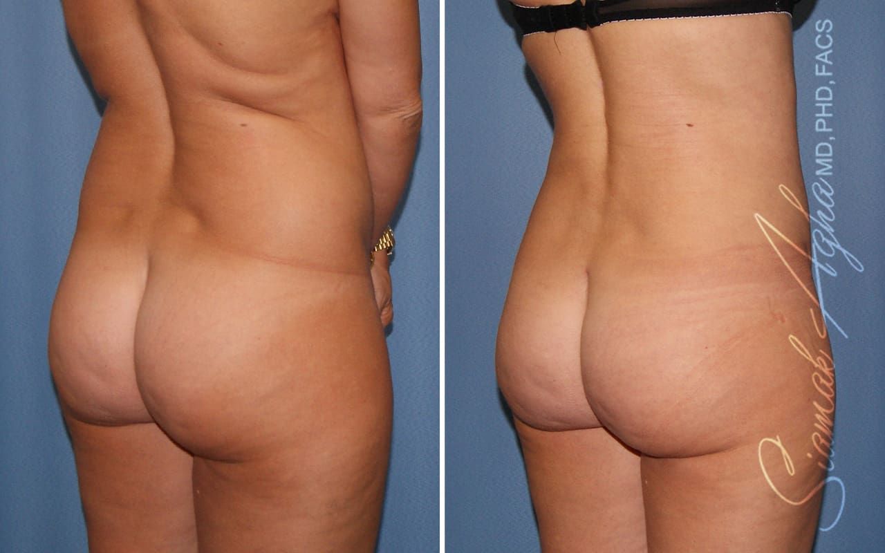 Partial Tummy Tuck Before & After