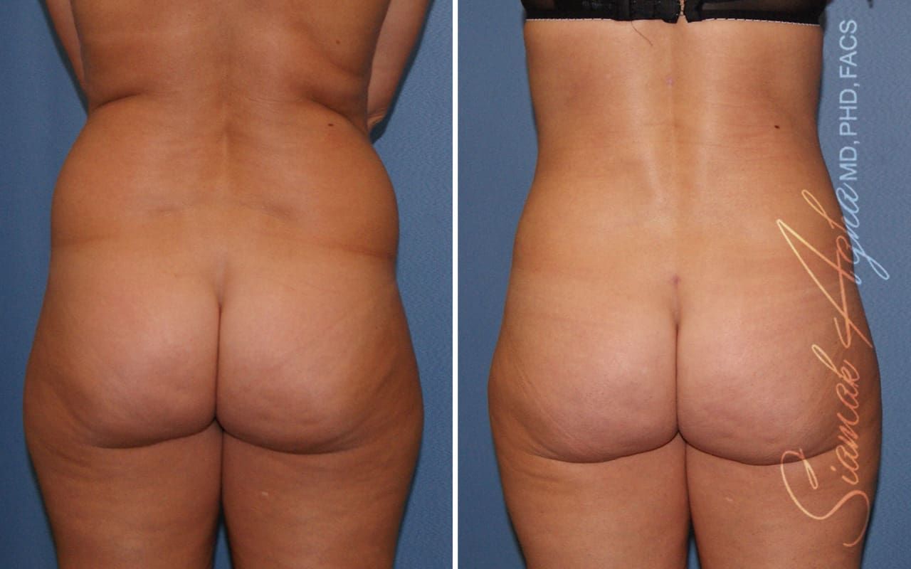 Partial Tummy Tuck Before & After