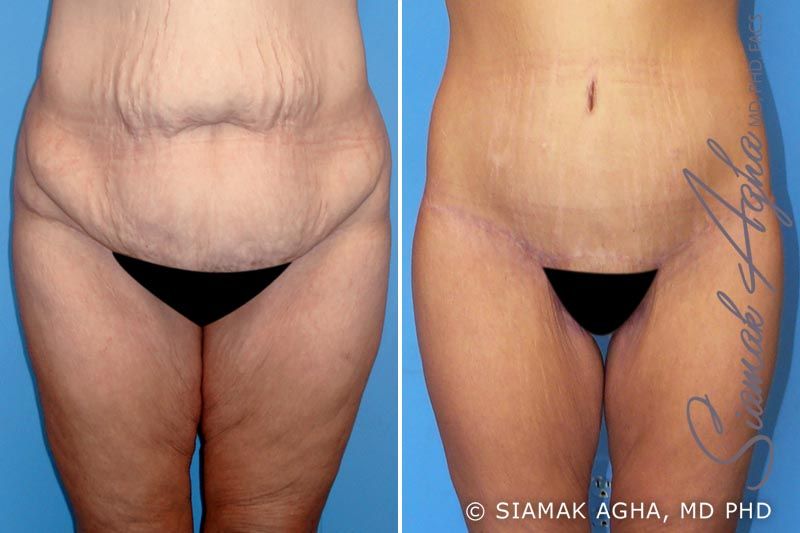 Spiral Thigh Lift Before & After