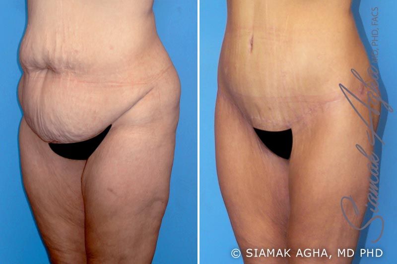 Spiral Thigh Lift Before & After