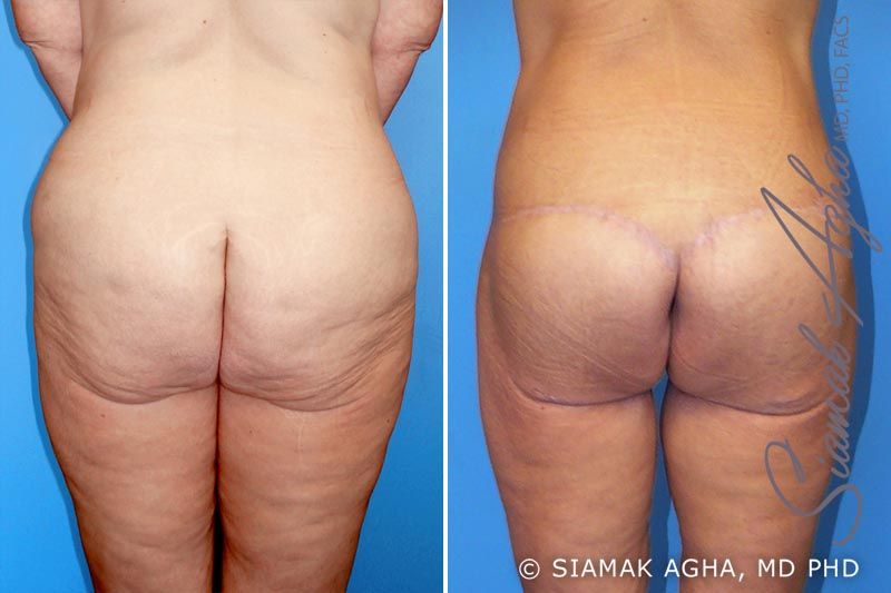 Spiral Thigh Lift Before & After