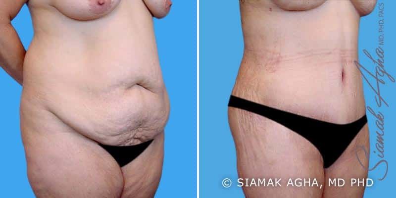 Spiral Thigh Lift Before & After