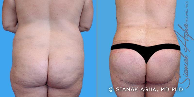 Spiral Thigh Lift Before & After