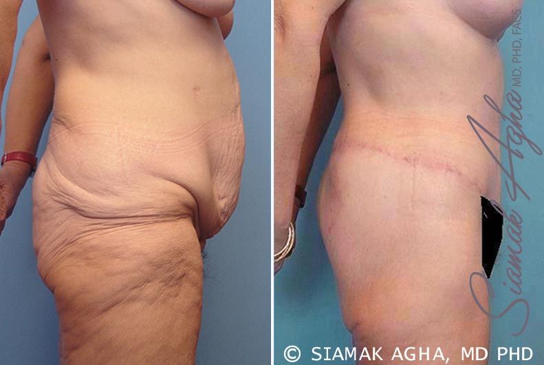 Spiral Thigh Lift Before & After