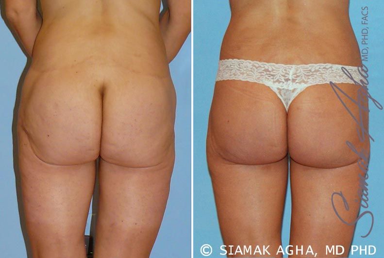 Spiral Thigh Lift Before & After