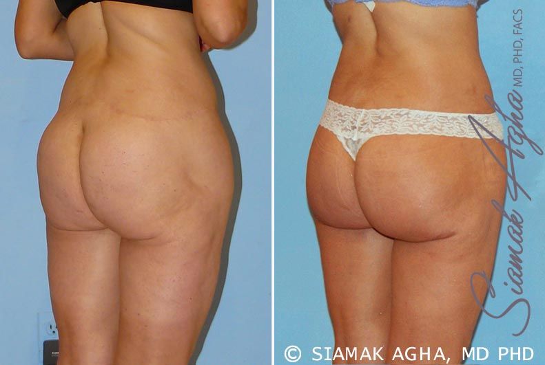 Spiral Thigh Lift Before & After