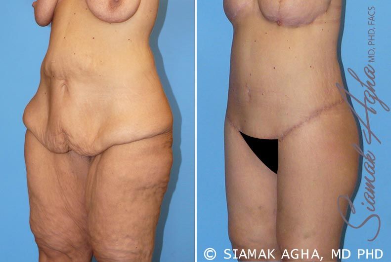 Spiral Thigh Lift Before & After