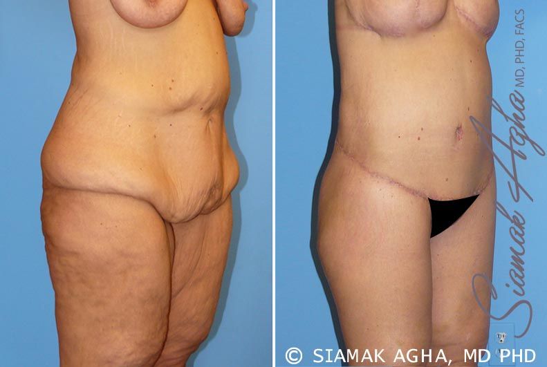 Spiral Thigh Lift Before & After