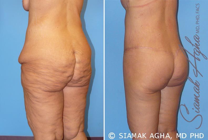 Spiral Thigh Lift Before & After