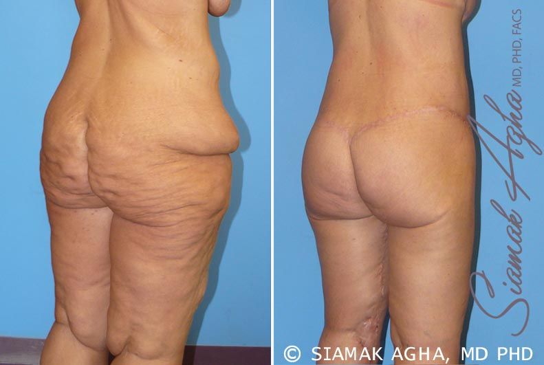Spiral Thigh Lift Before & After
