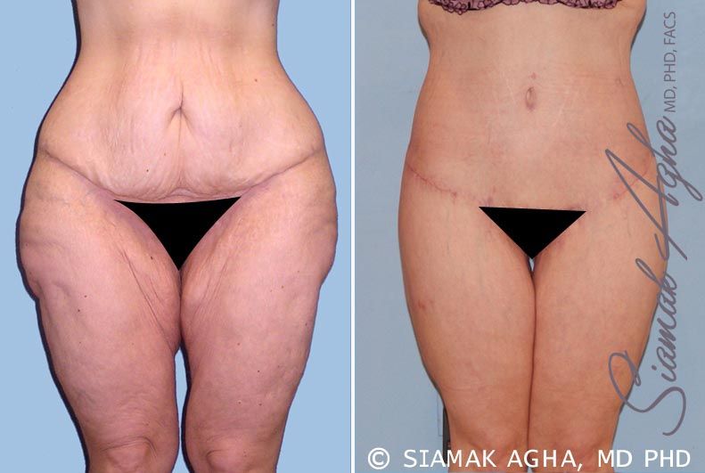 Spiral Thigh Lift Before & After
