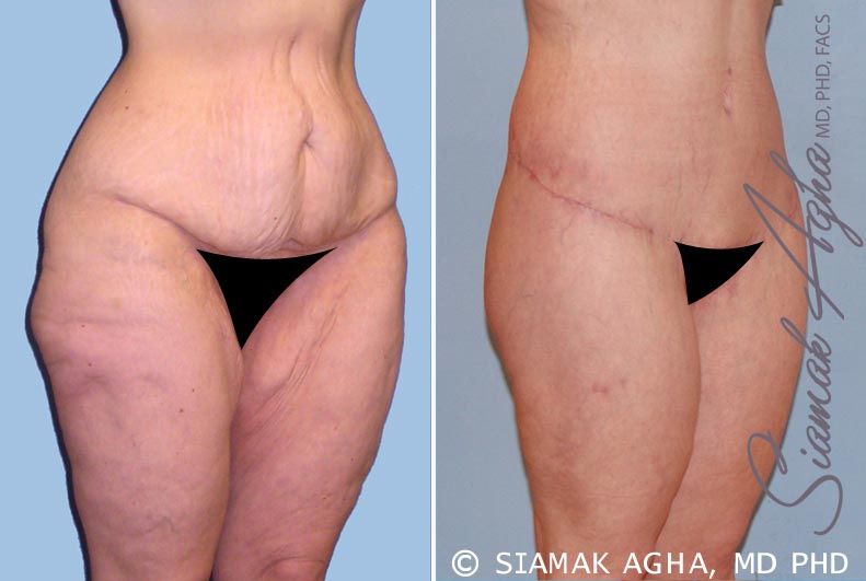 Spiral Thigh Lift Before & After