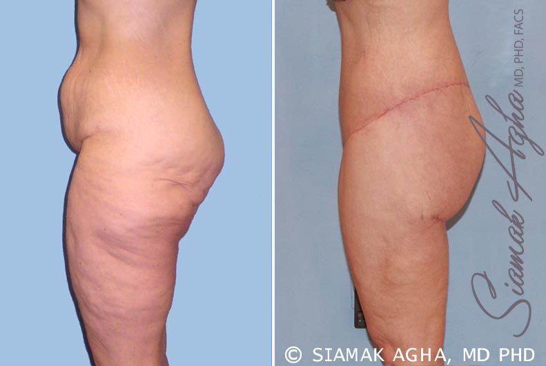Spiral Thigh Lift Before & After