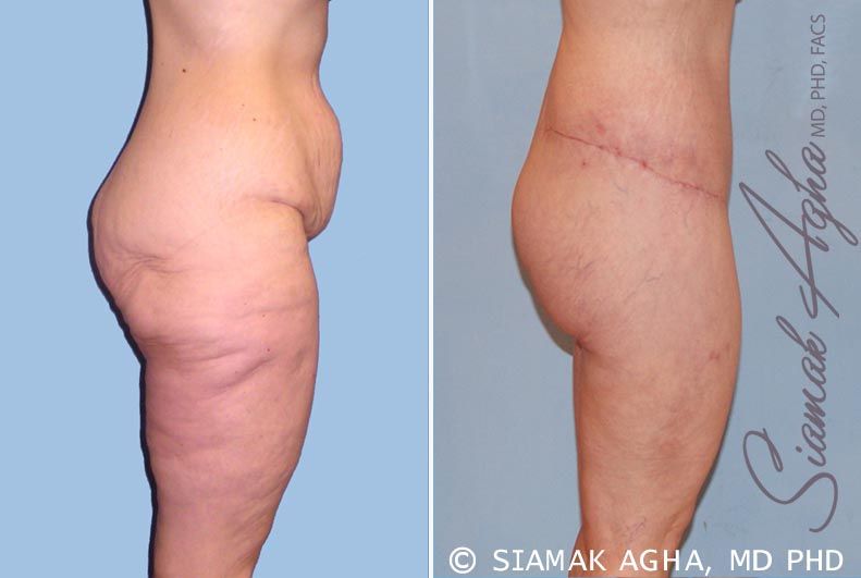 Spiral Thigh Lift Before & After
